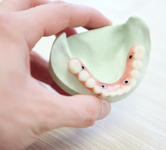 ایمپلنت دندان